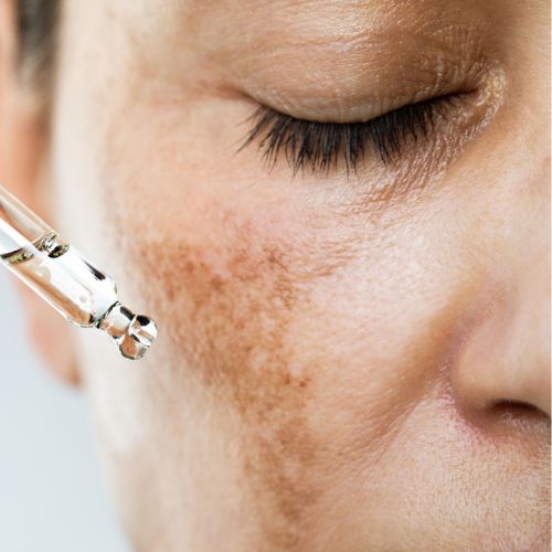 Face - Pigmentation Peel