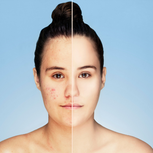 Face - Mild Skin Peel