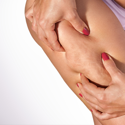 Cellulite Assistance & Lymph Drainage - Carboxy Therapy