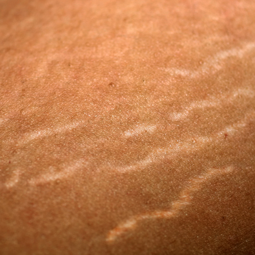 Stretch Marks Improvement - Microneedling