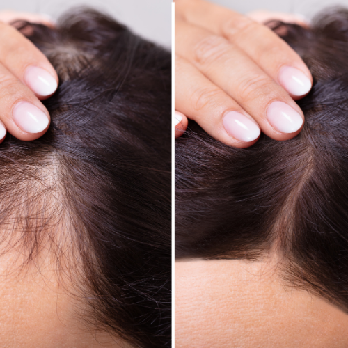 Hair & Scalp - Carboxy Therapy