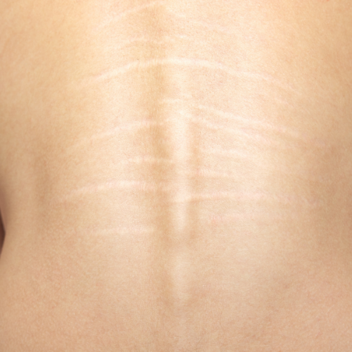 Stretch Marks Improvement - Carboxy Therapy